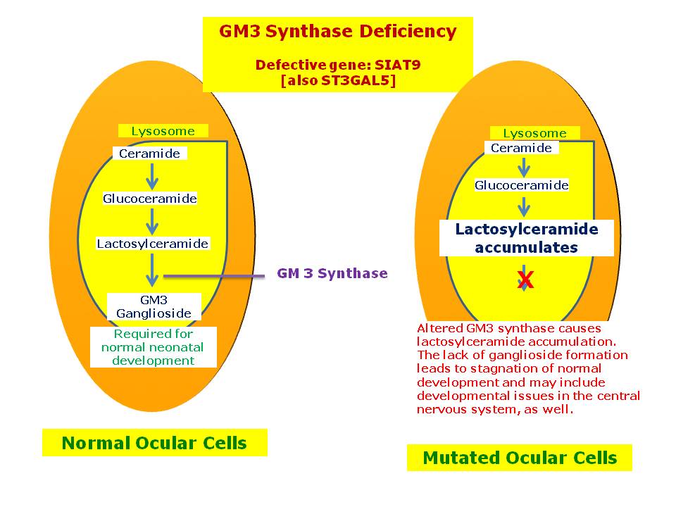 GM3 Synthase Deficiency | Hereditary Ocular Diseases